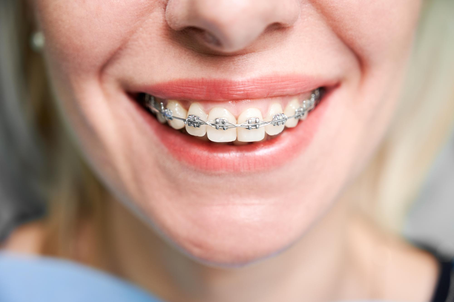 Braces & Teeth Alignment