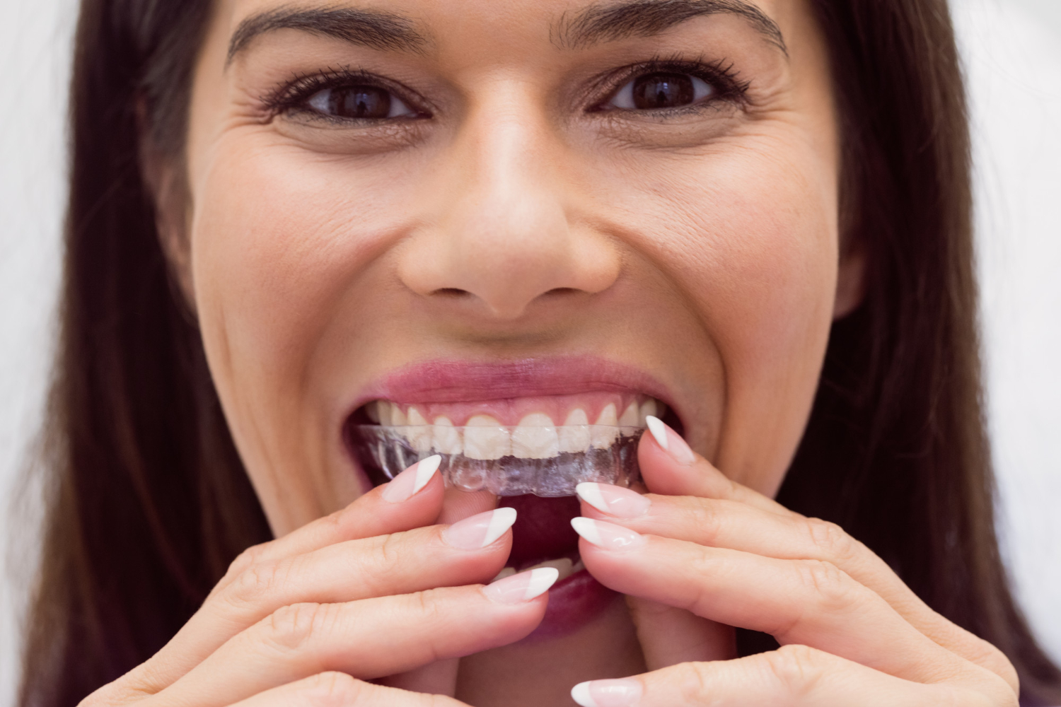 Invisalign® Clear Aligners